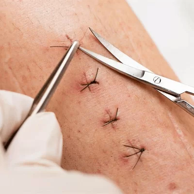 Suture Removal